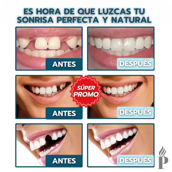 Denwhite®: Carillas Dentales Ajustables - Set Pzs Superior e inferior
